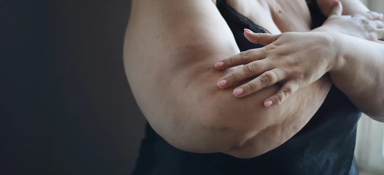 Psychosoziale Auswirkungen eines Lipödems: So bewältigen Sie die Belastung