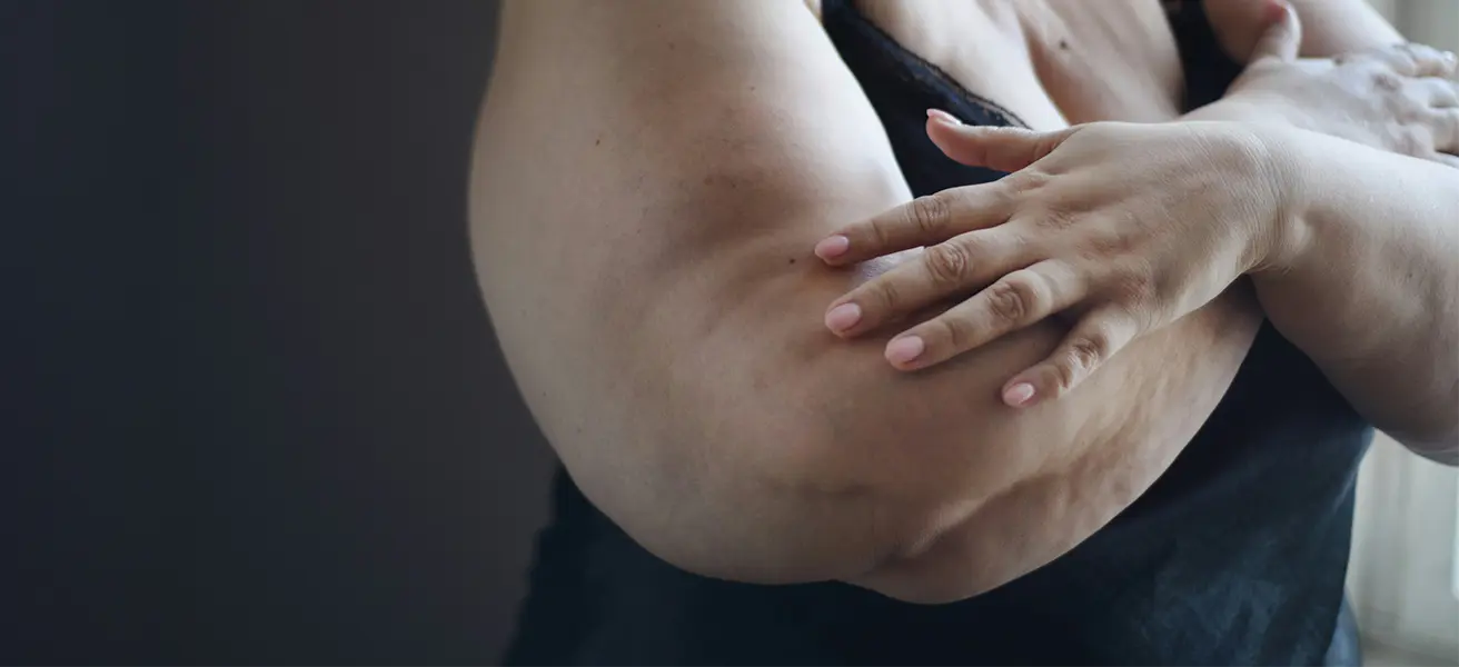 Psychosoziale Auswirkungen eines Lipödems: So bewältigen Sie die Belastung