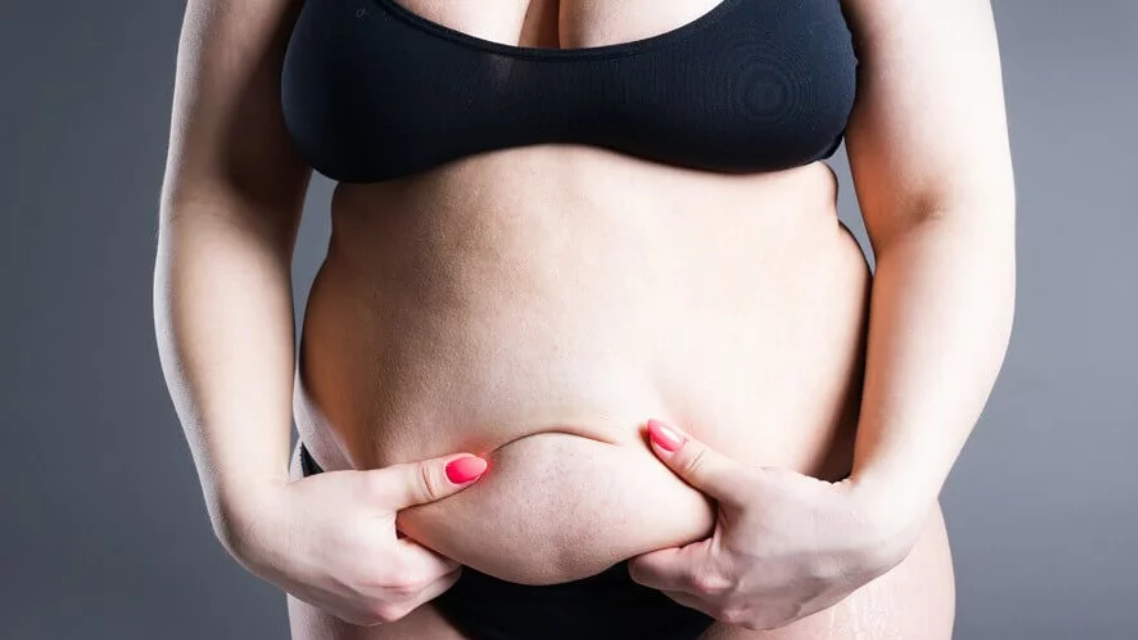 Lipödem Behandlung im Vergleich: Welche Therapien sind am effektivsten?